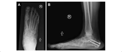 One Year Postoperative Weightbearing Radiographs Of The Same Patient