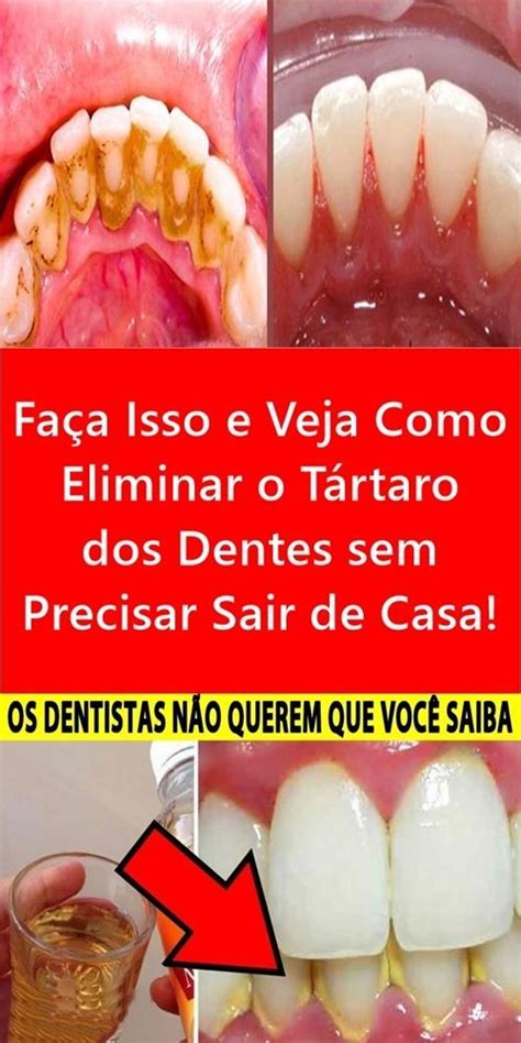 Fa A Isso E Veja Como Eliminar O T Rtaro Dos Dentes Sem Precisar Sair