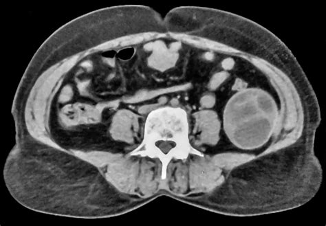 Ct Scan Of The Abdomen Showing Giant Multiloculated Hydatid Cyst With Download Scientific