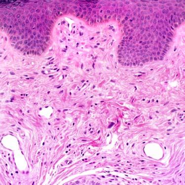 Fibrous Papule Histology