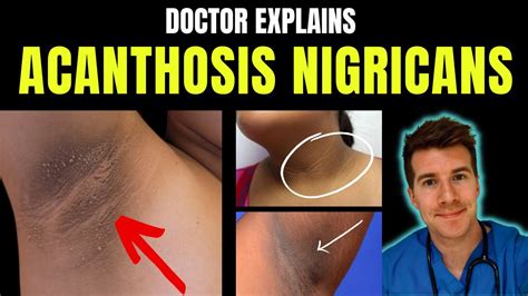 Doctor Explains Acanthosis Nigricans Signs Symptoms Causes