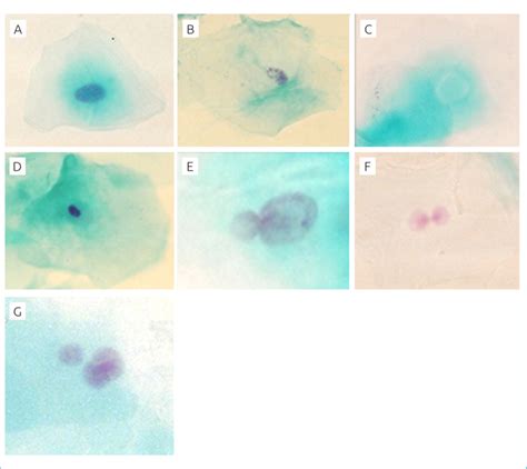 Nuclear alterations analyzed: (A) normal nucleus; (B) karyorrhexis; (C ...