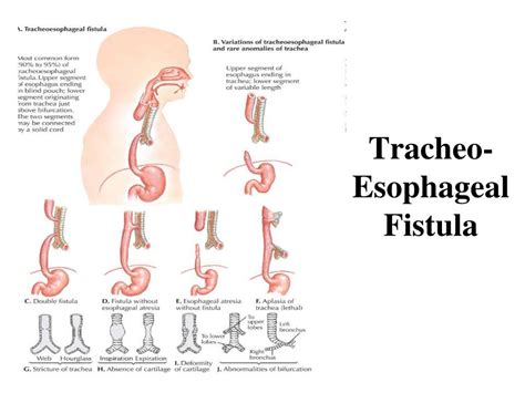 Ppt Trachea Powerpoint Presentation Free Download Id 5708611