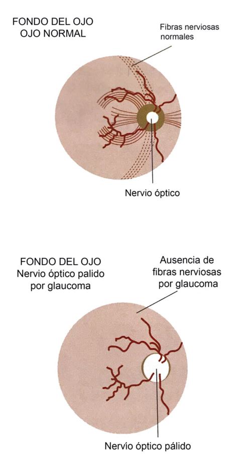 Cirugía De Glaucoma Centro Laser Ocular