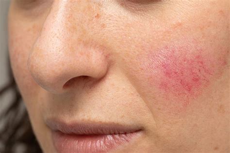 Best Rosacea Treatment Los Angeles And Santa Monica Dr Tanya Kormeili