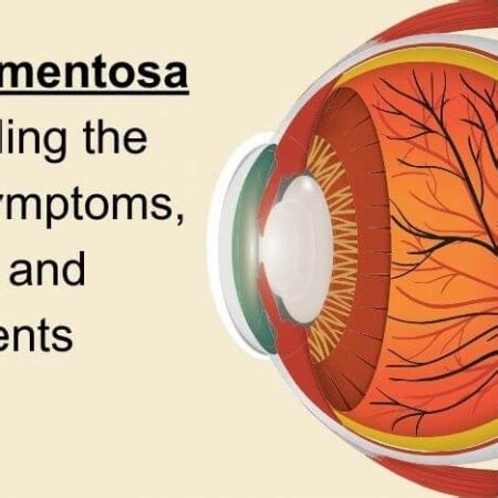 Retinitis Pigmentosa: Understanding the Condition, Symptoms, Causes ...