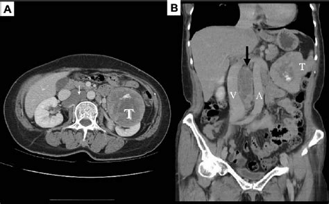 A Computed Tomography Reveals A Left Renal Heterogeneous Tumor T Download Scientific