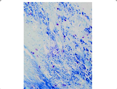 Toluidine Blue Stained Section Showing Mast Cells In Cyst Capsule