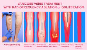 Vascular And Endovascular Surgery Udai Omni Hospital