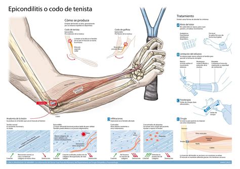 Dolor En Codo Epicondilitis Codo Del Tenista Síntomas Y Tratamiento Cun