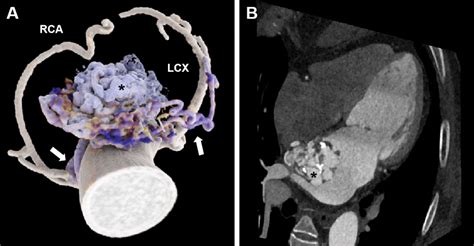 Cinematic Rendering Of Complex Coronary Artery Left Atrial Fistula