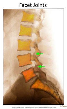 7 Lumbar Facet Joints shown on Color X-Rays and MRI Scans ideas | lumbar, medical medium, x ray