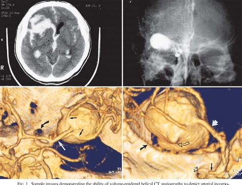 Figure 1 From Three Dimensional Helical Computerized Tomography Angiography In The Diagnosis