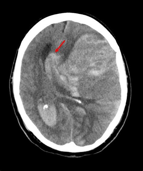 Image: Subfalcine Herniation - MSD Manual Professional Edition