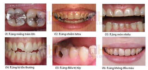 Dental Crowns And Bridges