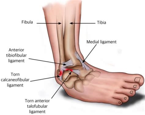 Ankle Sprains Learn Three Grades Of Ligament Sprain