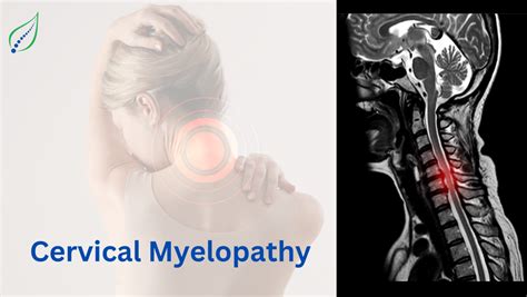 Cervical Myelopathy Care: Non-Surgical Expert in Pune | Best Back Pain ...