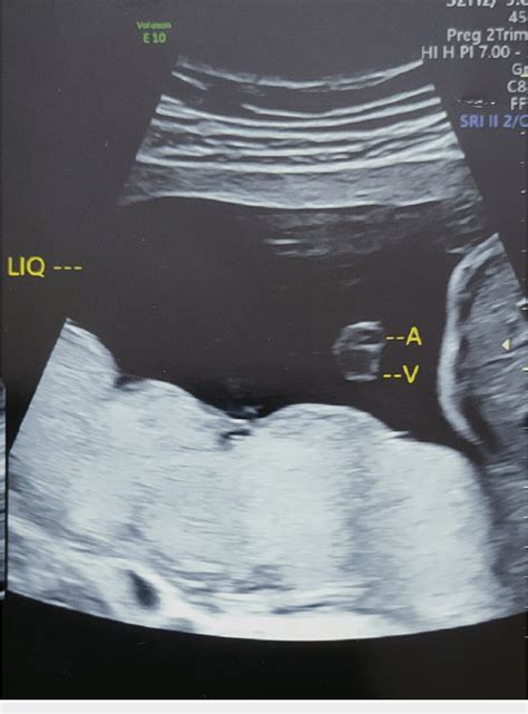 Figure 2 from Persistent Right Umbilical Vein in Association With ...