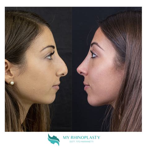 Rinoplastica Cose Da Sapere Prima Dell Intervento My Rhinoplasty