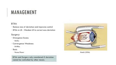 Exophoria Management - YouTube