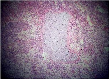 Pleuropulmonary Blastoma In Pediatric Age Group A Very Rare Case