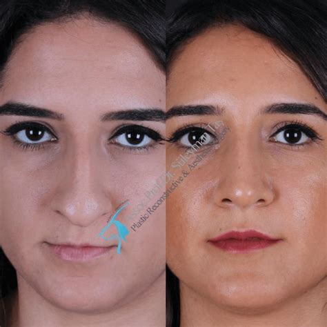 Rhinoplasty Surgery Nose Surgery Nostril Hoop Ring Nose Ring Best