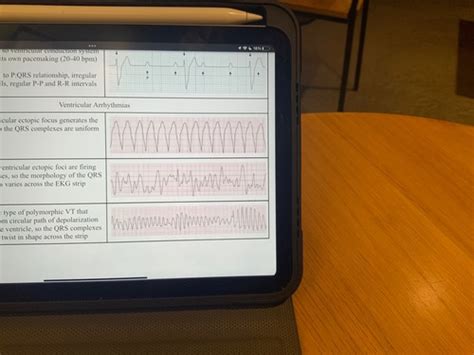 Intro To Arrhythmias Flashcards Quizlet