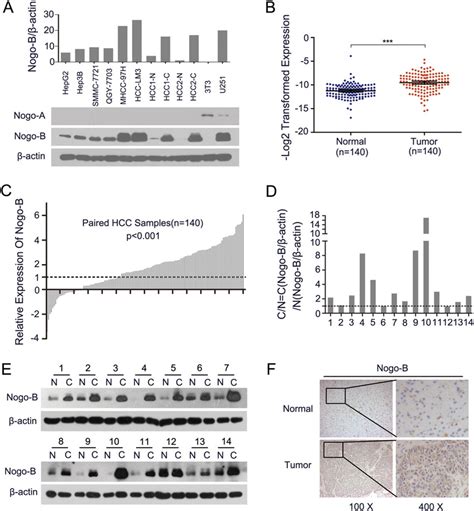 The Expression Of Nogo B Is Upregulated In Primary Hcc Tumor Tissues