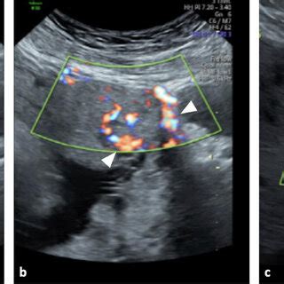 Grayscale A And Color Doppler B Transabdominal Ultrasound Images