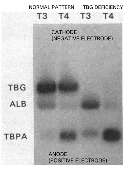 Thyroxine Binding Globulin - MyEndoConsult