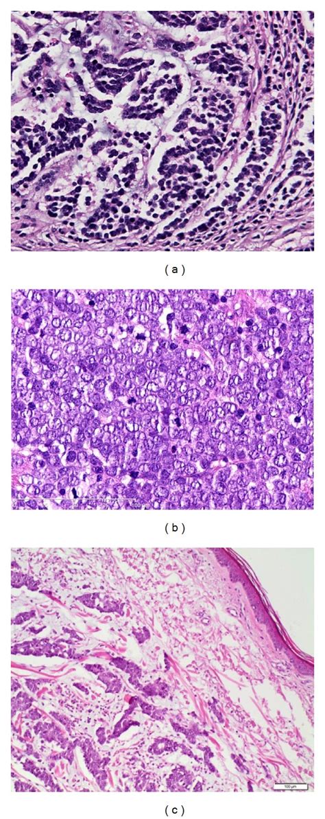 Histological Immunohistological And Clinical Features Of Merkel Cell