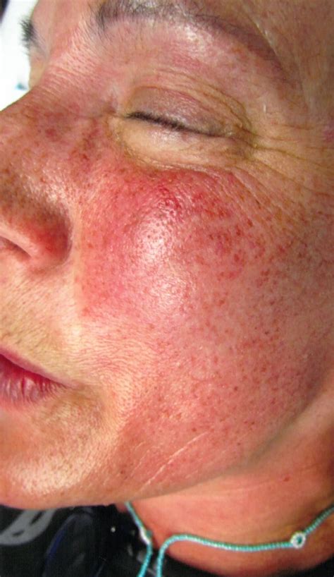 Rosacea Nose