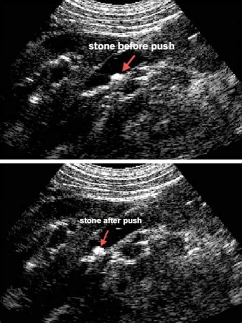 Kidney Stone Ultrasound