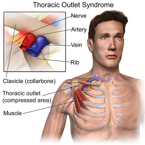 Rib Removal Surgery - Cost, Importance and Risks - Sutured