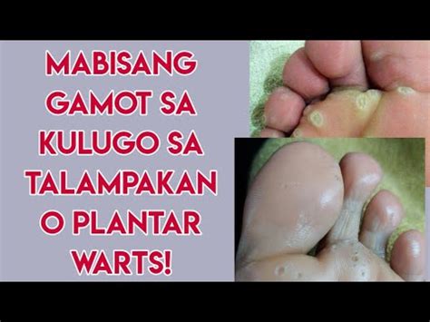 ANO ANG GAMOT SA KULUGO SA TALAMPAKAN O PLANTAR WARTS YouTube