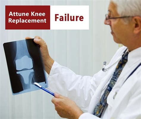 Attune Knee Replacement Failure Lawsuit