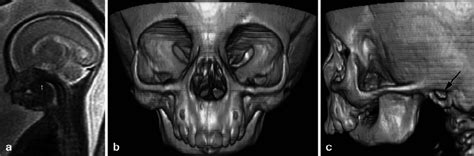 Robin sequence. a Fetal MR SSFSE T2-weighted sagittal image reveals ...