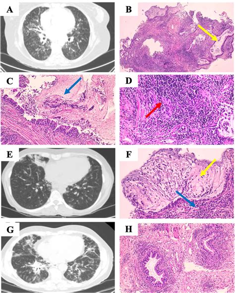 Granulomatous Lymphocytic Lung Interstitial Disease Glild A Diagnostic Challenge Report Of