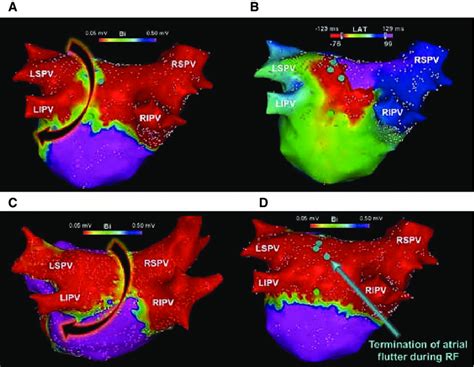 Electroanatomic Maps Created At Repeat Procedures D Voltage A And