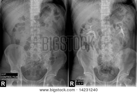 Intravenous Pyelogram Image & Photo (Free Trial) | Bigstock