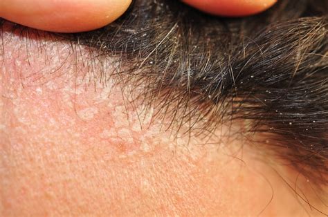 Dermatite seborreica o que é quais sintomas e como tratar