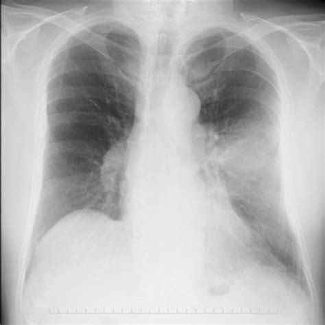 Chest radiography image upon presentation | Download Scientific Diagram