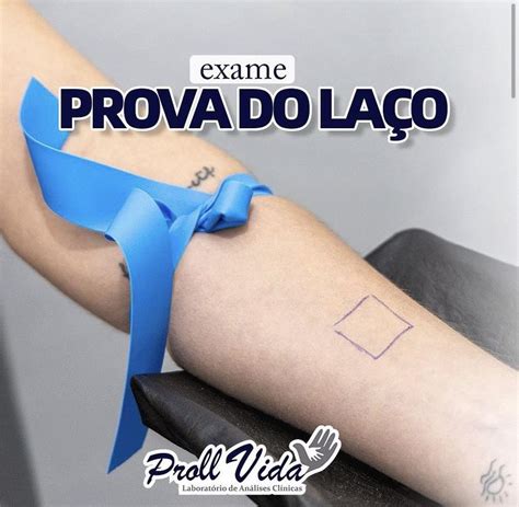 Prova De Laço Dengue - Prova Do Laço Positiva - RETOEDU