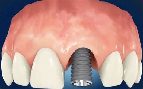 Implant zęba jakie są rodzaje implantów ile kosztuje cena implantów