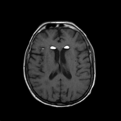 Epidermoid Cyst Brain Mri