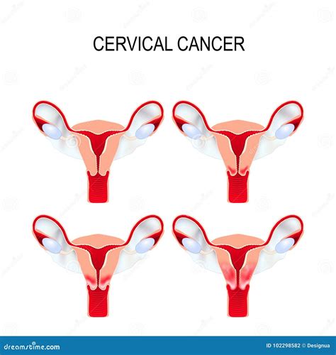 Cervical Cancer Staging Carcinoma Of Cervix Stock Vector