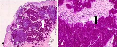 Figure From A Case Of Tumoral Calcinosis At The Auricle Semantic