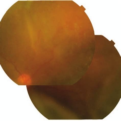 The fundus photographs showed no sign of retinal detachment. | Download ...