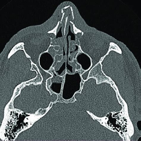 CT image of a 55-year-old man after physical assault. Note nasal septal... | Download Scientific ...