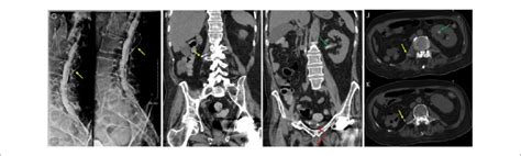 Computed Tomography Ct Myelogram X Ray Myelogram With Intrathecal Download Scientific